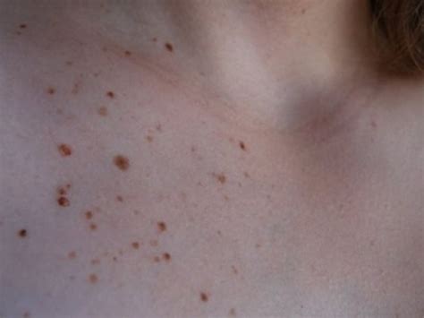 Il dégénère dans environ 5 % des cas. Grain De Beauté Qui Grossit Et Change De Couleur - Choix ...