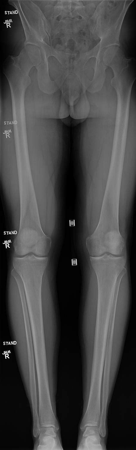 ACL Tear - Knee & Sports - Orthobullets