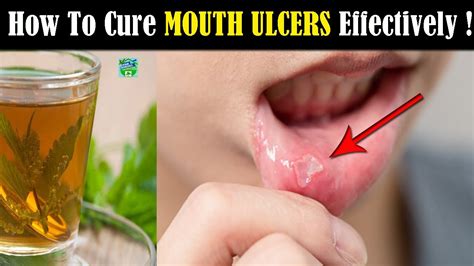 Maybe you would like to learn more about one of these? How To Cure Mouth Ulcers Naturally And Effectively ! - YouTube