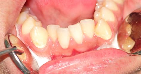 Maddahi is able to fix crooked teeth with veneers. Fix Crowded Teeth with Invisalign, Veneers & Other Solutions