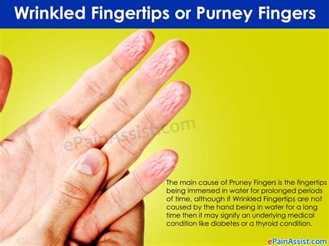 Numbness and tingling are the symptoms most often associated with peripheral neuropathy, though other symptoms exist. The main cause of wrinkled fingertips or pruney fingers is ...