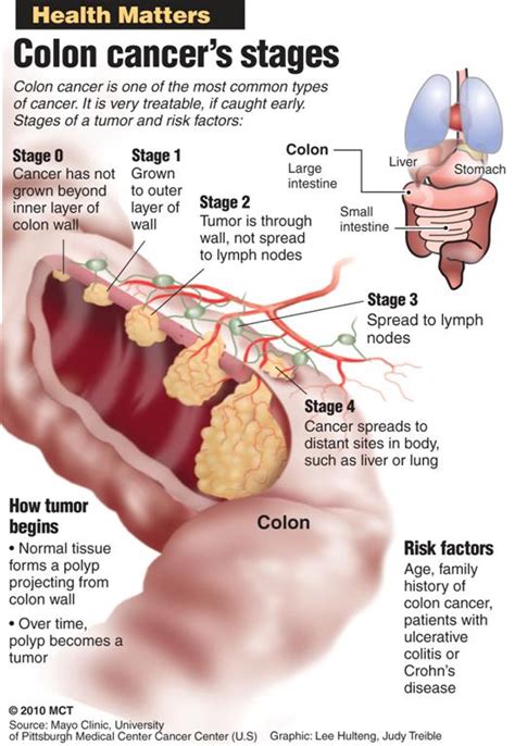 I am a stage iii colon cancer survivior, advocate and speaker. Prevention Better than Cure Tips and Campaign powered by ...