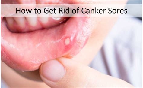 Go see your dentist but make sure he and the staff know of your canker sore. What Causes Canker SORES?