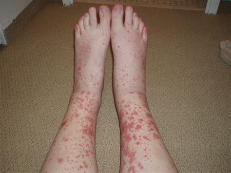 Most of the time the only symptoms of mcv infection is the rash. Leukocytoclastic vasculitis - Cancer Therapy Advisor