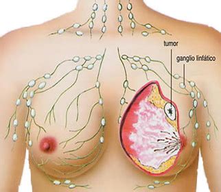 Nyeri di payudara, cara aman menyembuhkan benjolan nyeri di payudara tanpa menimbulkan efek samping, cara ampuh mengobati benjolan nyeri bahkan saat ini sudah ada dokter dan para herbalis yang meresepkan daun sirsak untuk mengatasi beberapa penyakit. Obat Benjolan Di Payudara | Obat Benjolan Di Payudara