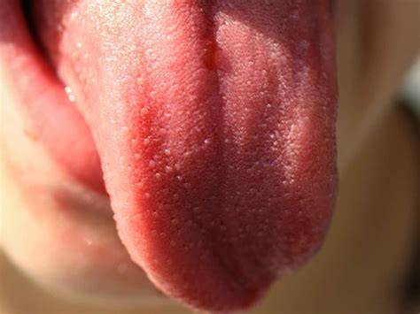 Strawberry tongue: New COVID-19 symptom discovered