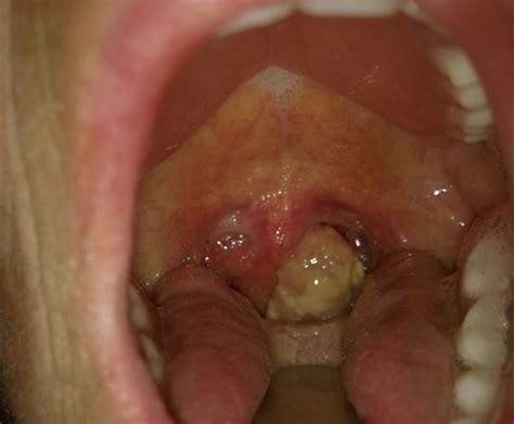 Sore throat and hoarseness that. Throat Cancer - Pictures, Survival rate, Symptoms, Causes ...