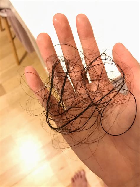 In some cases, it can even require a visit to the hospital. What it's like to live with chronic hair loss - Chronic ...