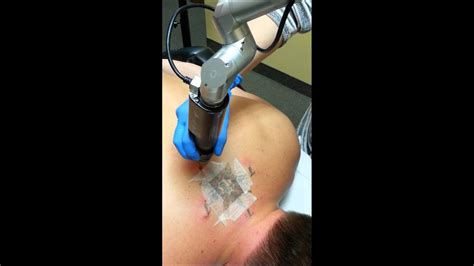 Riehm of skin deep laser md discusses options for tattoo removal. PicoSure Tattoo Removal at Contour Clinic - YouTube