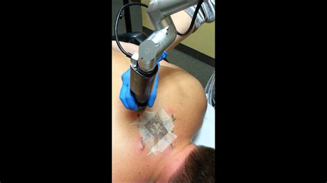 You've changed, and a tattoo can be a constant reminder of a different time and place. PicoSure Tattoo Removal at Contour Clinic - YouTube