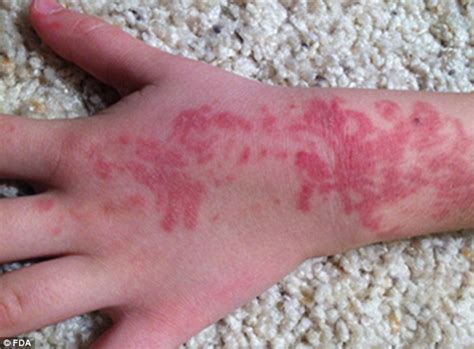 Studies have found that at least 69% of people will suffer a reaction to black henna if it's left on the skin for 120 minutes or more, which is common when it's applied as a temporary 'tattoo'. FDA warns about hidden dangers of 'temporary' henna ...