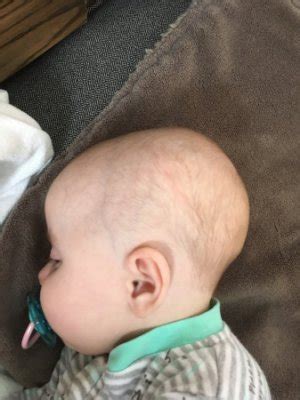 Now since my delivery started complete lower part pain. Occipital bone sticks out? - October 2017 - BabyCenter Canada