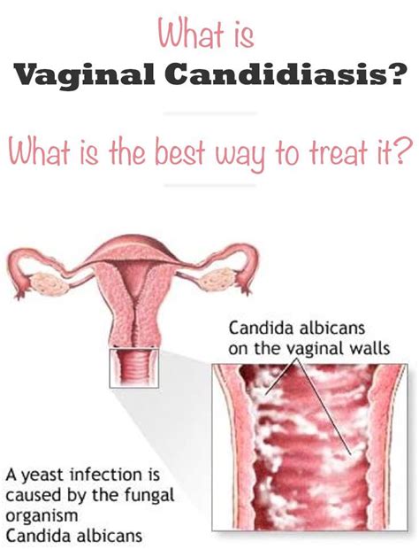 Find out the symptoms, what causes them and but, male yeast infections have not been studied enough and researchers are unsure how many men are affected yearly. Yeast Infection Male Home Remedy-Male Yeast Infection ...