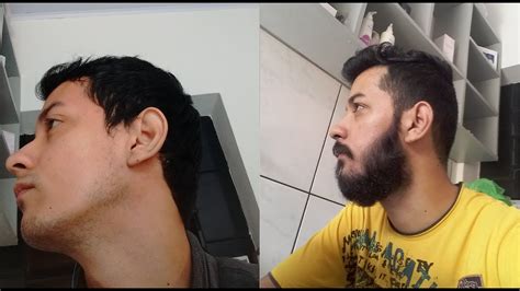 The dropper (pipette) that comes with the liquid is the ideal way to get the active ingredient, directly where it needs to be. Minoxidil antes e depois 6 meses | Minoxidil before after - 6 months - beard - YouTube