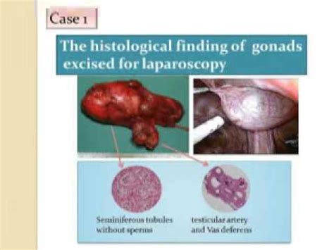 Även för de ärftliga autoinflammatoriska sjukdomarna de genetiska. The three cases of AIS Androgen Insensitivity Syndrome ...