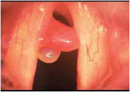 The size of vocal cords affects the pitch of voice. CHAPITRE 2 : DYSPHONIE EN RAPPORT AVEC LA PARALYSIE ...