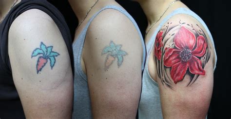 Yes, you can get a tattoo after laser removal. Can Tattoos Be Removed Completely? What You Need To Know