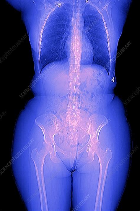 They are also commonly referred to as the rear end or the bum (especially with children). Female body, CT scan - Stock Image - C001/7358 - Science Photo Library