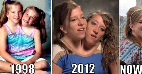 Maybe you would like to learn more about one of these? 20 Interesting Things About Famous Conjoined Twins Abby ...