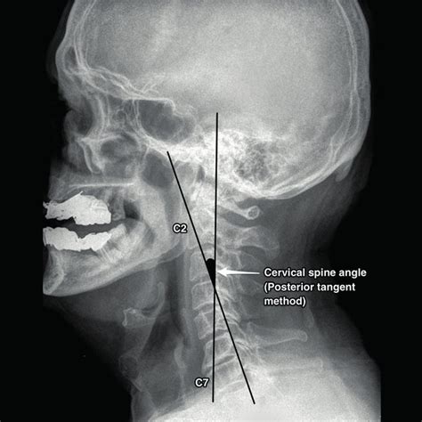 Of or relating to lordosis; e measurement of C2-C7 total cervical lordosis angle with ...