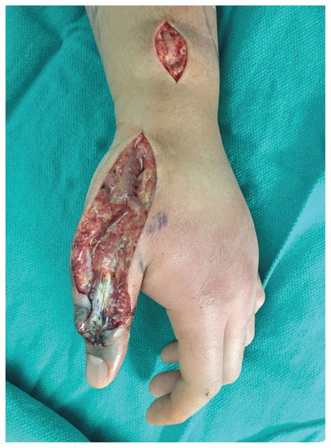 Necrotizing fasciitis — ▪ pathology rapidly spreading infection of the underlying skin and fat layers caused by a variety of pathogenic bacteria, principally streptococcus pyogenes. Necrotizing fasciitis after scalpel injury sustained ...