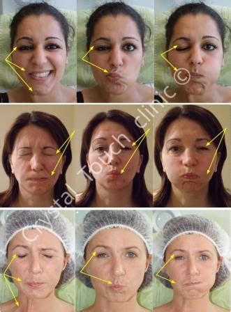 Physical therapy and exercises for bell's palsy may help your condition improve sooner. What is Synkinesis? - Crystal Touch Bell's Palsy Clinic