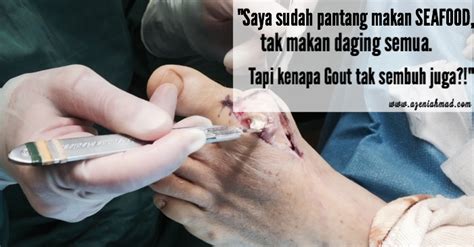 Bacaan asid urik bagi pesakit gout selalunya melebihi 540 mcmol/l. 3 Cara Rendahkan Asid Urik - Sakit Gout - azeniahmad.com