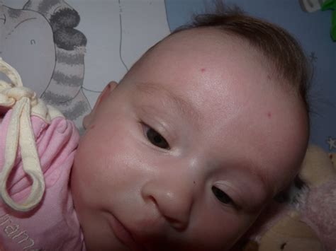 « le petit bouton rouge, c'est un motif de consultation assez fréquent en pédiatrie : Louane a des petits boutons sur le visage - Bébés de ...