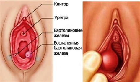 Почему образуются жировики на теле? Уплотнение на больших пол губах фото | Блог о здоровье и детях