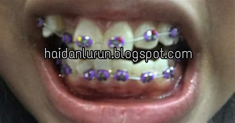 Lubang yang terhasil yg dibiarkan lama dan tidak dirawat menyebabkan akar gigi itu terkena jangkitan. NADDY HERE: BRACES ON FINALLY