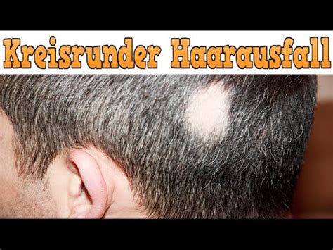 Authoritative facts from dermnet new zealand. Kreisrunder Haarausfall, Alopecia Areata, Alopecia Areata ...