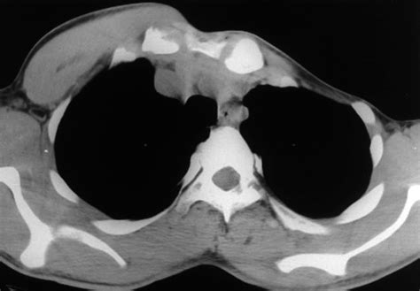 How is my case evaluated? Thorax 30