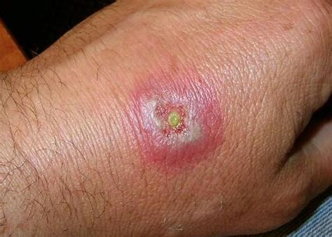 Symptoms of a poisonous spider bite are definitely something to take very seriously. Hobo Spinnenbiss: Was Sie wissen müssen - DeMedBook