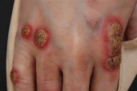 Tuberculosis is curable and preventable. Moulage, Tuberculosis verrucosa cutis (Hand) [G. S ...