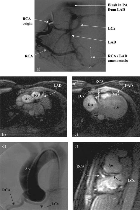 We hope you will use this picture in the study and. Coronary Artery Imaging in Grown Up Congenital Heart ...