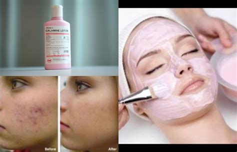 Calamine lotion for the skin is used to treat itching and skin irritation caused by chickenpox, insect bites or stings, measles, eczema, sunburn, poison ivy, poison oak, and poison sumac and other minor skin conditions. 8 Amazing Benefits Of Calamine Lotion | Makeupandbeauty.com