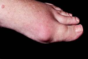 Panel Issues Consensus Statement on Management of Gouty Arthritis of the Foot and Ankle ... Gout  