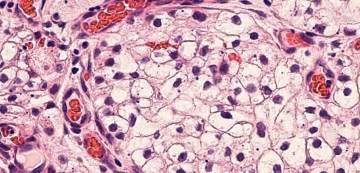 Find updated content daily for mesothelioma tumor. Study: Mesothelioma Tumor Cells Can Generate Their Own ...