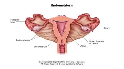 Women with endometriosis develop tissue that looks and acts like endometrial tissue outside the uterus, usually on other reproductive organs inside the pelvis or in the abdominal cavity. Endometriosis in Girls | Children's Hospital Colorado