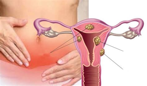 Adalah dipercayai bahawa fibroid rahim muncul terutamanya pada wanita dari 35 hingga 50 tahun. Ramai wanita tak tahu ada fibroid | Harian Metro