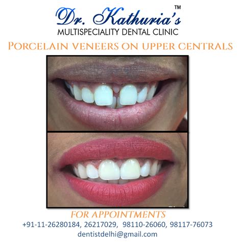 A small gap in front teeth (< 2mm in size) can be easily treated by using tooth coloured fillings. #PorcelainVeneers on Upper Centrals at Dr. Kathuria's ...