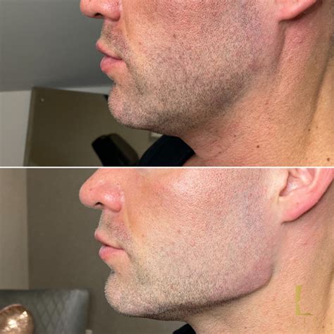 I do not recommend waiting for the last opportunity to take the sat. Beautiful Jaw Filler Transformations in Our Luxury Clinic