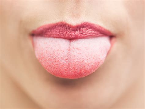 See full list on mayoclinic.org Tongue Tied? What Your Tongue's Appearance Can Tell You ...