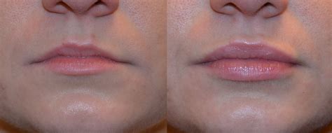 We did not find results for: Pin by SB Aesthetics Medical Spa on Before & After ...