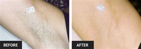 A survey by the american laser centers showed that women spend more than $10,000 on shaving products laser hair removal is a medical procedure that must be performed by certified technicians. Laser Hair Removal Before and After Pictures | Laser Lipo ...