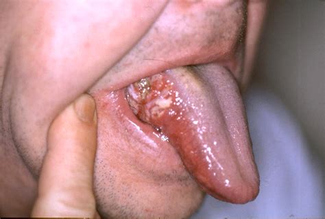 A canker sore looks like an ulcer, usually with a depression in the center. The First Sign You've Got Oral Cancer