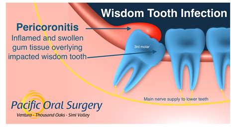 Cysts, or pockets of fluid, can form around the tooth, and in some rare c. Wisdom Tooth Infection Pacific Oral Surgery - Pacific Oral ...