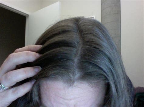 In addition to ageing, other causes of grey hair include genetics, stress, nutrient deficiencies, and health problems. CAUSES OF GREY HAIR AT AN EARLY AGE