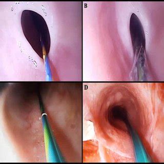 People with this condition have problems swallowing due to small, thin growths of. (PDF) Endoscopic Management of Dysphagia in Plummer-Vinson ...