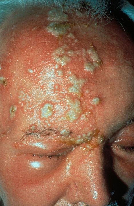 Hsv 2 virus is a type of hsv simple known as herpes simplex 2. Spotlight On… Shingles | skinawareness.org